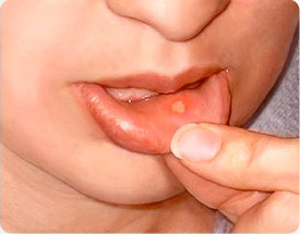 canker sores