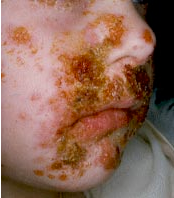 Impetigo