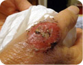 MRSA on Hand